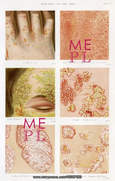 : Diseases of the Skin - Plate 5 : Diseases of the Skin - Plate 5