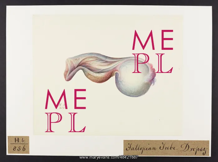 : Dropsy: Fallopian Tuve : Dropsy: Fallopian Tuve
