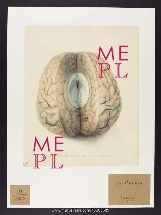 : Dropsy of the Fifth Ventricle : Dropsy of the Fifth Ventricle