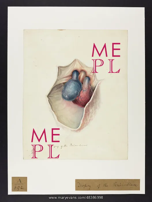 : Dropsy of the Pericardium : Dropsy of the Pericardium