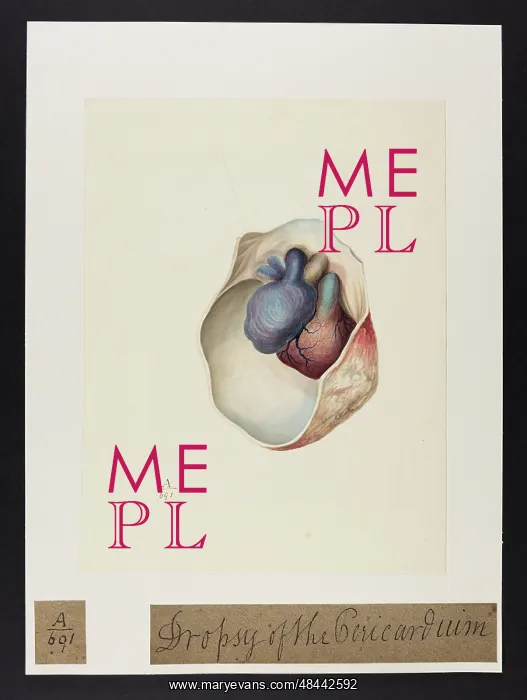 : Dropsy of the Pericardium : Dropsy of the Pericardium