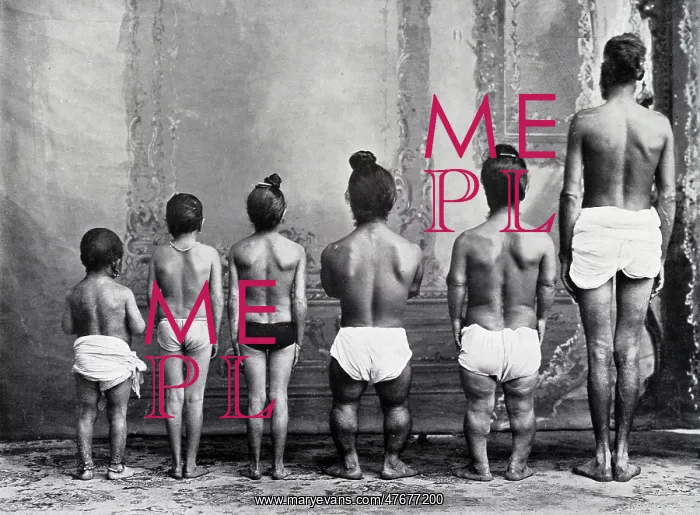 : Dwarfism, 1910 : Dwarfism, 1910