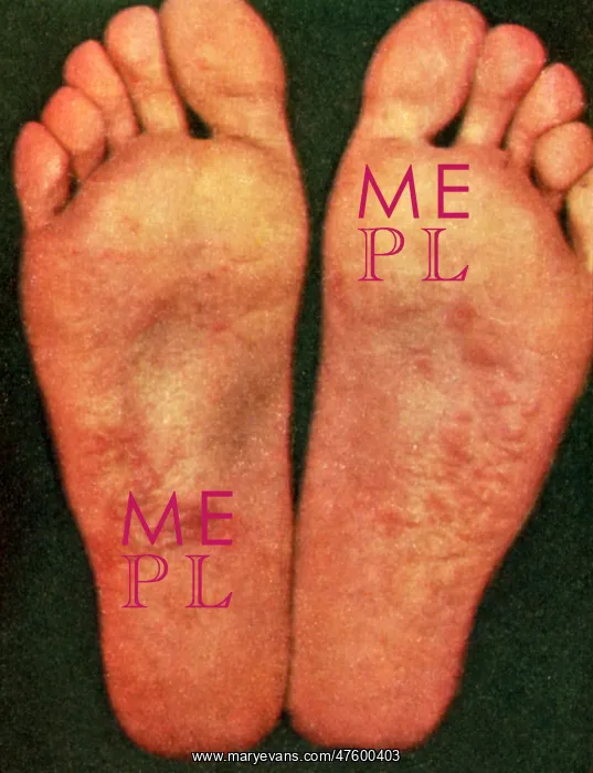 : Dyshidrosis : Dyshidrosis