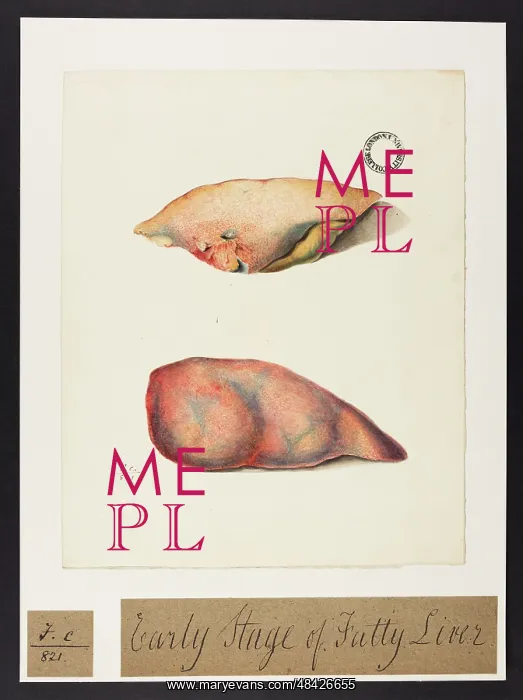 : Early Stage of Fatty Liver : Early Stage of Fatty Liver