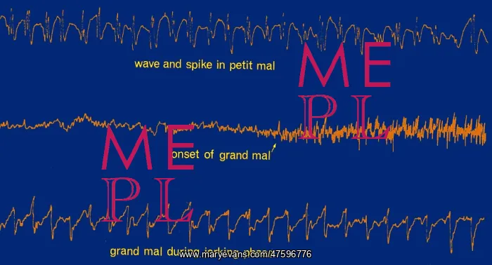 : EEG of Epileptic Seizures : EEG of Epileptic Seizures