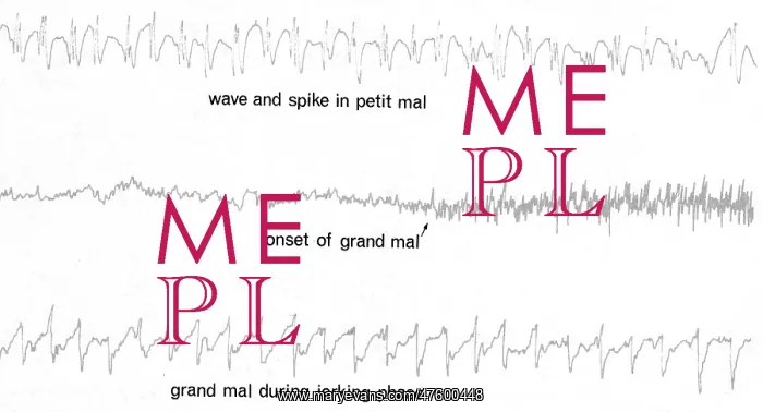 : EEG of Epileptic Seizures : EEG of Epileptic Seizures