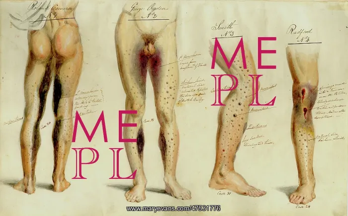  : Effects of Scurvy