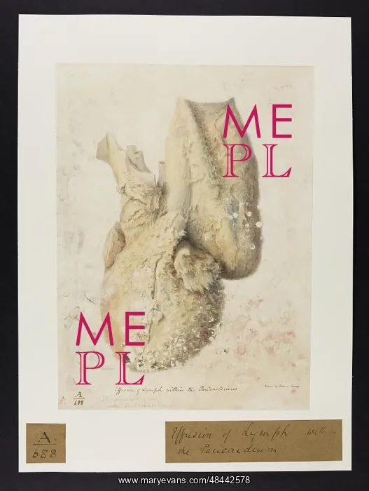 : Effusion of Lymph Within the Pericardium : Effusion of Lymph Within the Pericardium