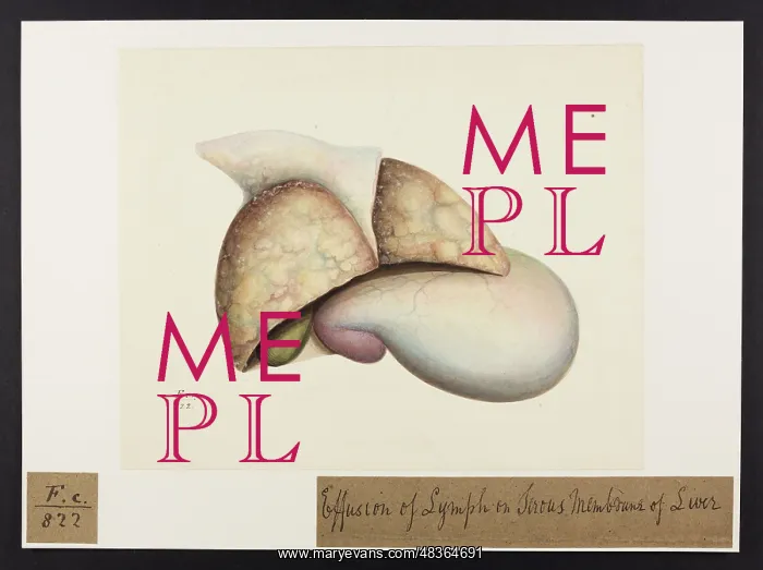: Effusion of Lymph on Serous Membrane of Liver : Effusion of Lymph on Serous Membrane of Liver