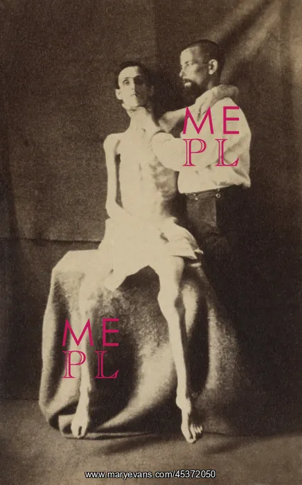 : This emaciated Union soldier was released : This emaciated Union soldier was released