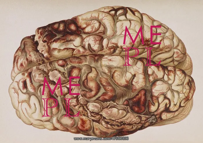 : Encircling Gunshot-Wound in Brain, 1898 : Encircling Gunshot-Wound in Brain, 1898