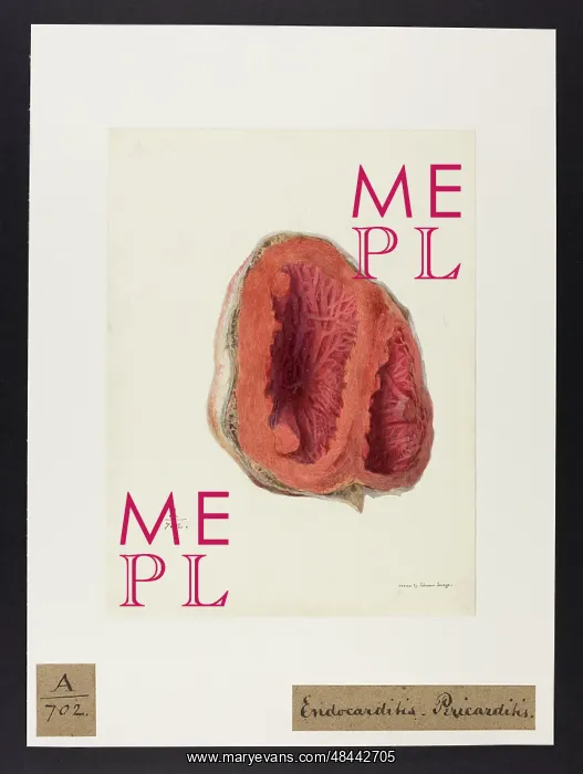 : Endo-Carditis, Pericarditis : Endo-Carditis, Pericarditis