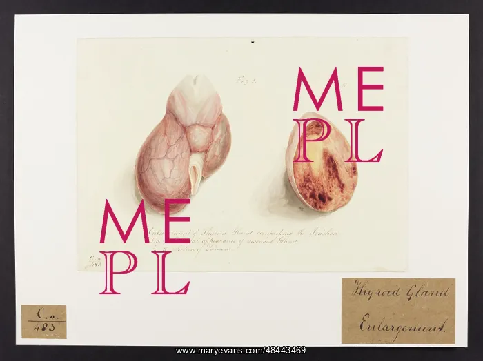 : Enlargement of the Thyroid Gland : Enlargement of the Thyroid Gland