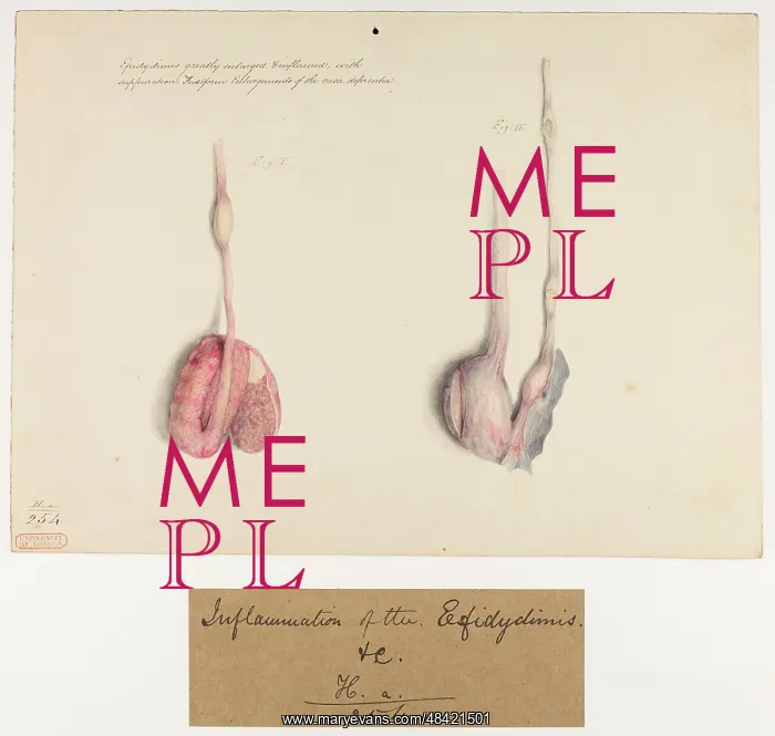 : Epidydimis Enlarged and Inflamed with Suppuration : Epidydimis Enlarged and Inflamed with Suppuration