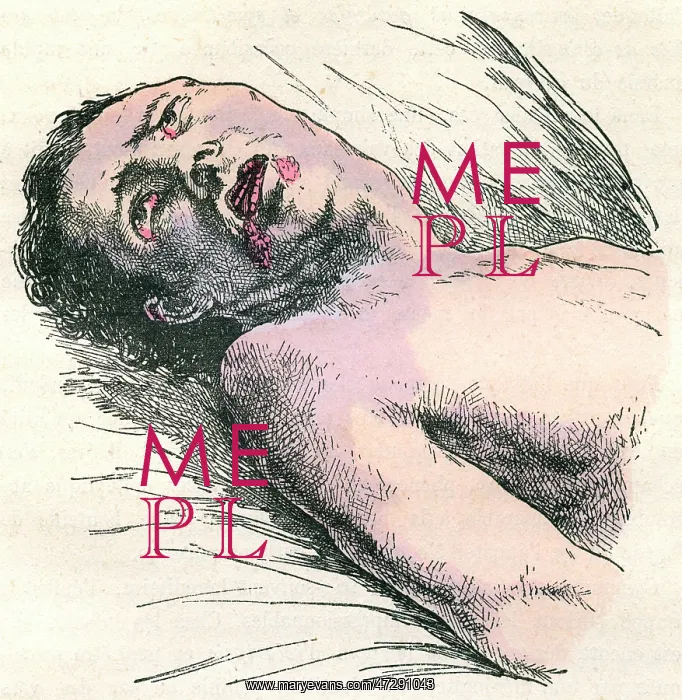 : EPILEPSY. Diagram to show an unconscious victim of a strong epilectic attack : EPILEPSY. Diagram to show an unconscious victim of a strong epilectic attack