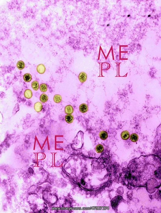 : Epstein-Barr Virus, TEM : Epstein-Barr Virus, TEM