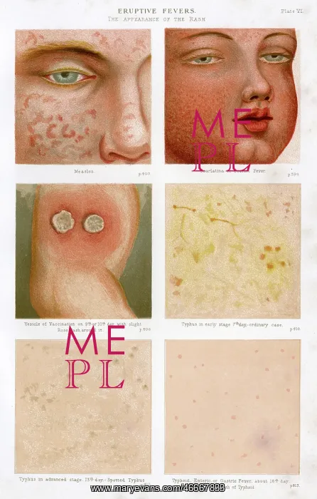 : Eruptive Fevers - Plate 6 : Eruptive Fevers - Plate 6