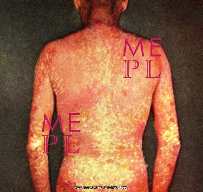 : Erythroderma : Erythroderma