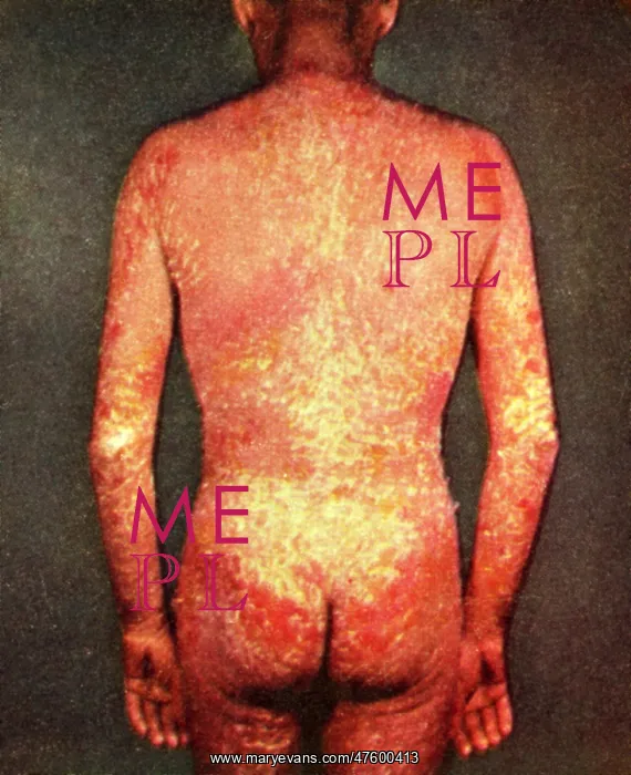 : Erythroderma : Erythroderma