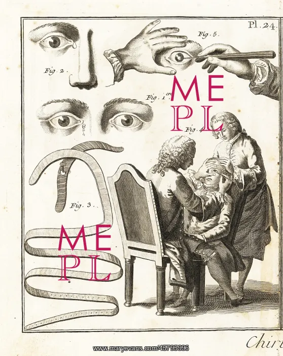 : Eye surgery, 18th century : Eye surgery, 18th century