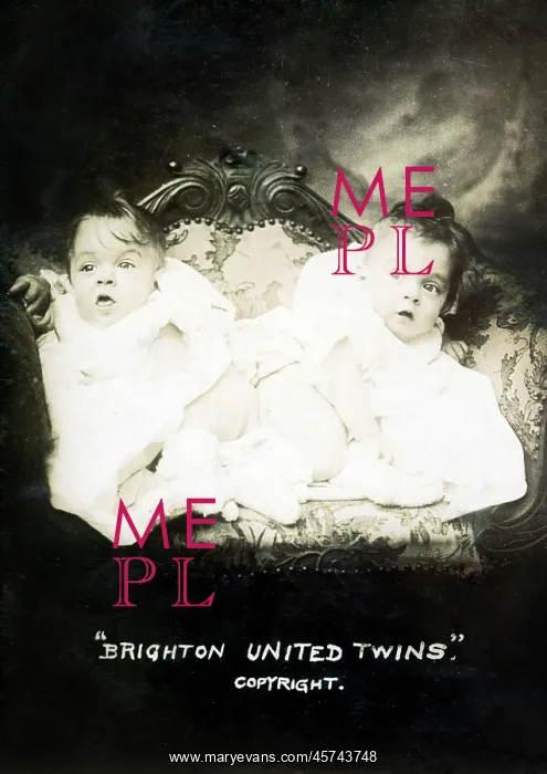 : Famous conjoined sisters Daisy and Violet Hilton : Famous conjoined sisters Daisy and Violet Hilton