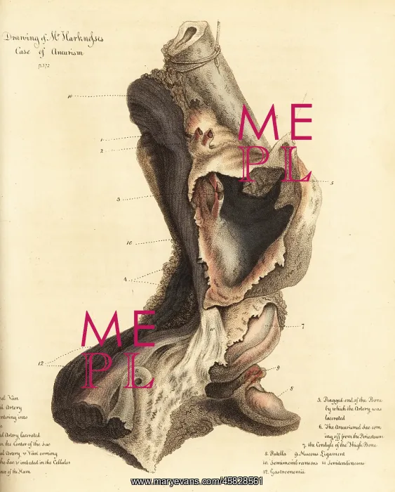 : Fatal aneurysmal sac from the broken leg of a man, 1815 : Fatal aneurysmal sac from the broken leg of a man, 1815