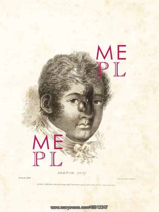 : Fatal tumor on the face of a gentleman from Birmingham : Fatal tumor on the face of a gentleman from Birmingham