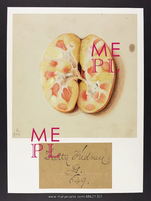 : Fatty Kidneys and Liver : Fatty Kidneys and Liver