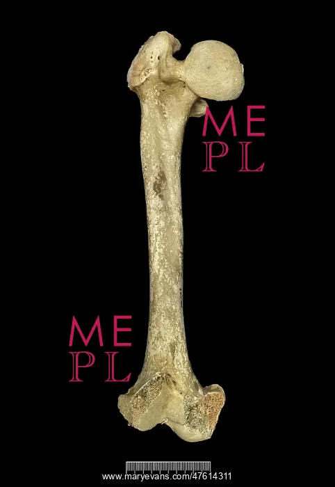 : Femur of Achondroplastic Dwarf : Femur of Achondroplastic Dwarf