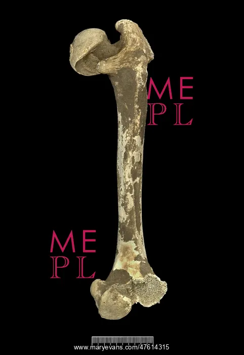 : Femur of Achondroplastic Dwarf : Femur of Achondroplastic Dwarf