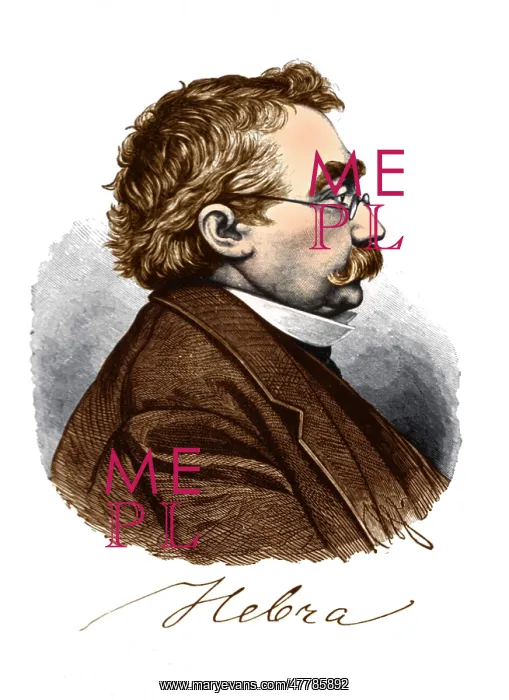 : Ferdinand von Hebra, German Dermatologist : Ferdinand von Hebra, German Dermatologist