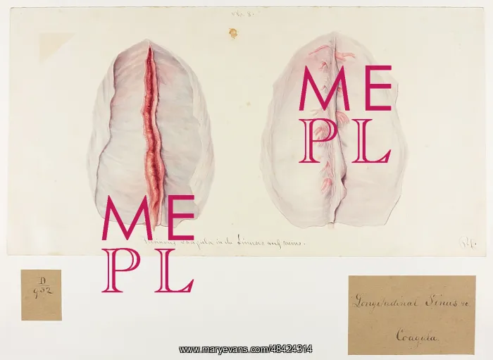 : Fibrinous Coagula: Sinuses and Veins : Fibrinous Coagula: Sinuses and Veins