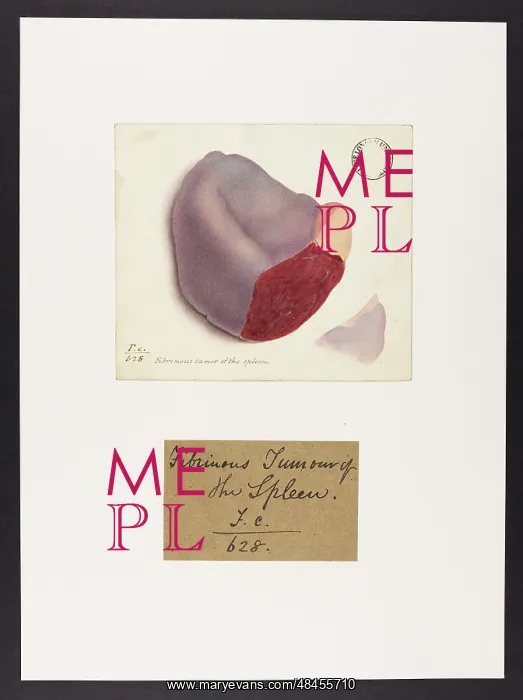 : Fibrinous Tumour of the Spleen : Fibrinous Tumour of the Spleen