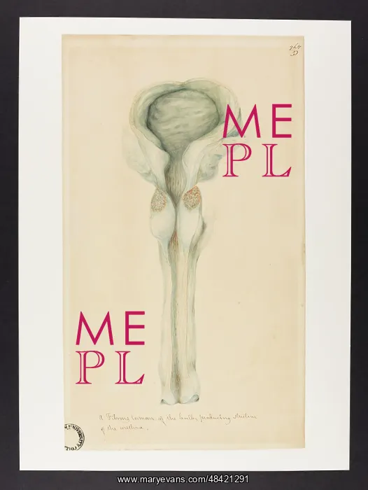: Fibrous Tumour of the Bulb Producing Stricture of Urethra : Fibrous Tumour of the Bulb Producing Stricture of Urethra
