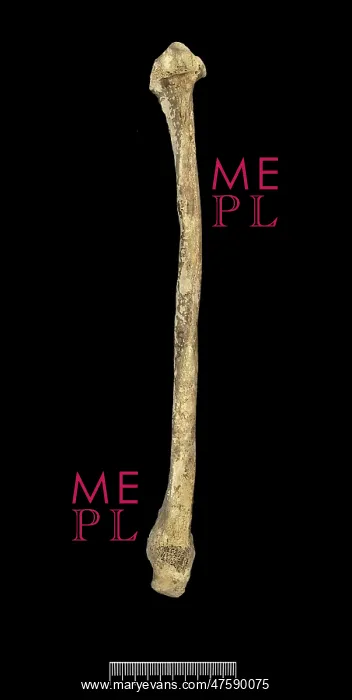 : Fibula of Achondroplastic Dwarf : Fibula of Achondroplastic Dwarf