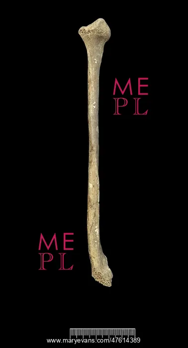 : Fibula of Achondroplastic Dwarf : Fibula of Achondroplastic Dwarf