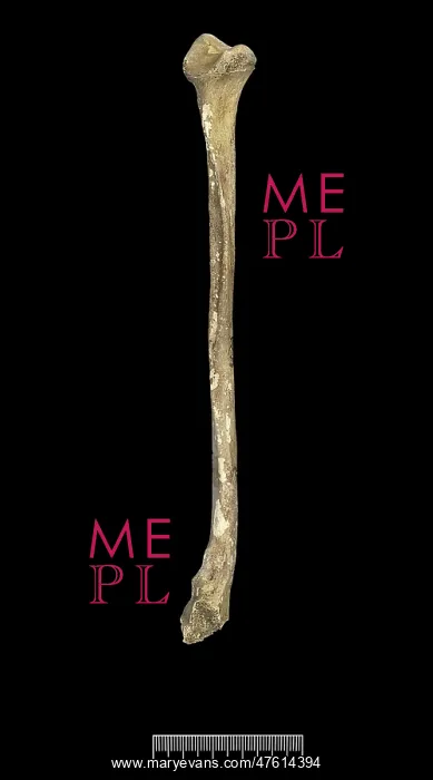 : Fibula of Achondroplastic Dwarf : Fibula of Achondroplastic Dwarf