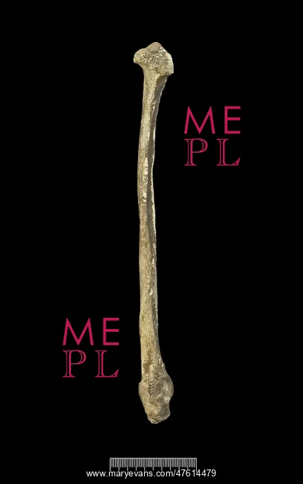 : Fibula of Achondroplastic Dwarf : Fibula of Achondroplastic Dwarf