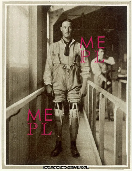 : First attempt to walk with new limbs 1915 : First attempt to walk with new limbs 1915