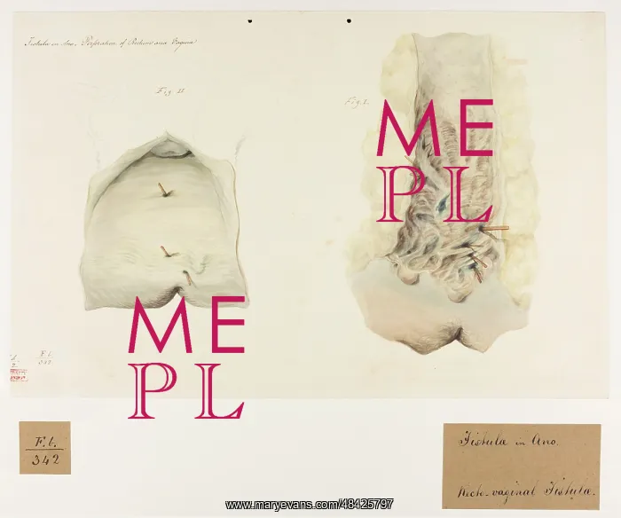 : Fistula in Ano, Perforation of Rectum and Vagina : Fistula in Ano, Perforation of Rectum and Vagina