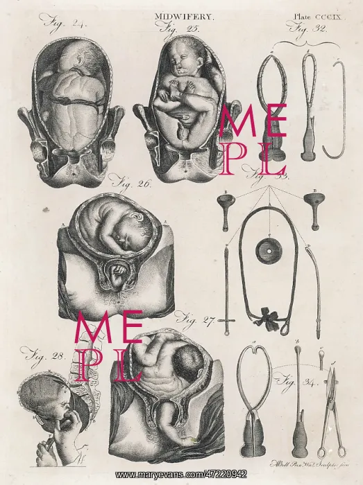 : FOETUS AND INSTRUMENTS : FOETUS AND INSTRUMENTS