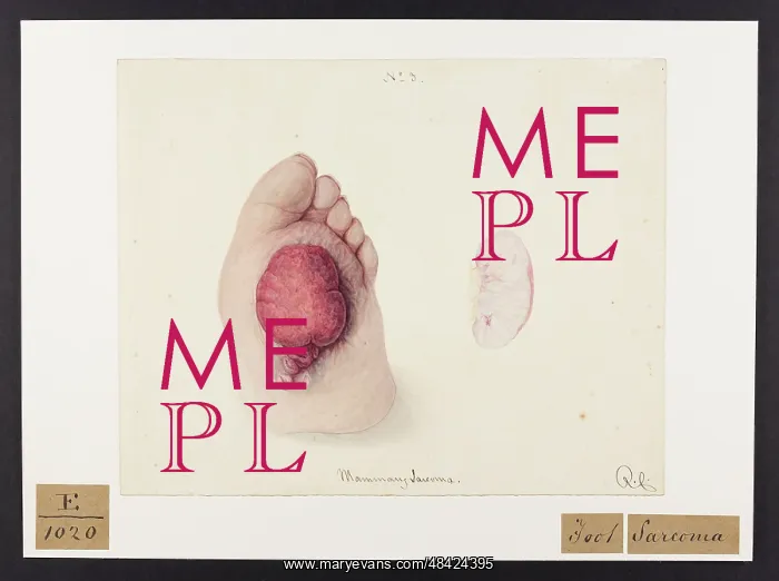 : Foot and Mammory Sarcoma : Foot and Mammory Sarcoma