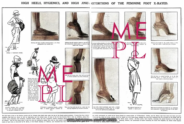 : Foot x rays showing damage done by wearing high heels : Foot x rays showing damage done by wearing high heels