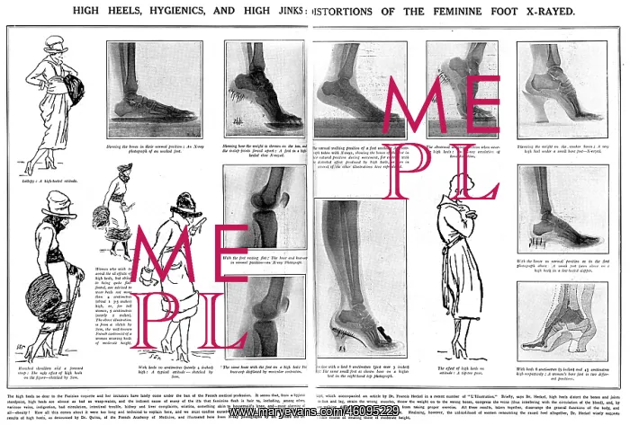 : Foot x rays showing damage done by wearing high heels : Foot x rays showing damage done by wearing high heels