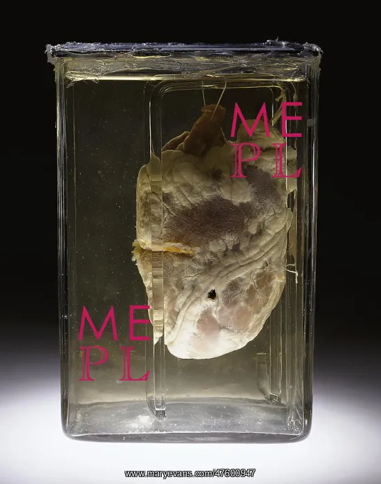 : Forensic Evidence, Heart Perforated by Bullet, 1937 : Forensic Evidence, Heart Perforated by Bullet, 1937