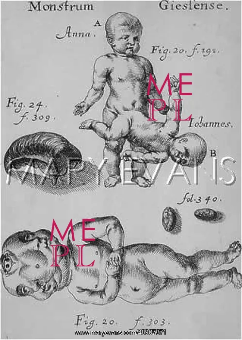 : FREAK BIRTHS / GERMANY / C17 : FREAK BIRTHS / GERMANY / C17