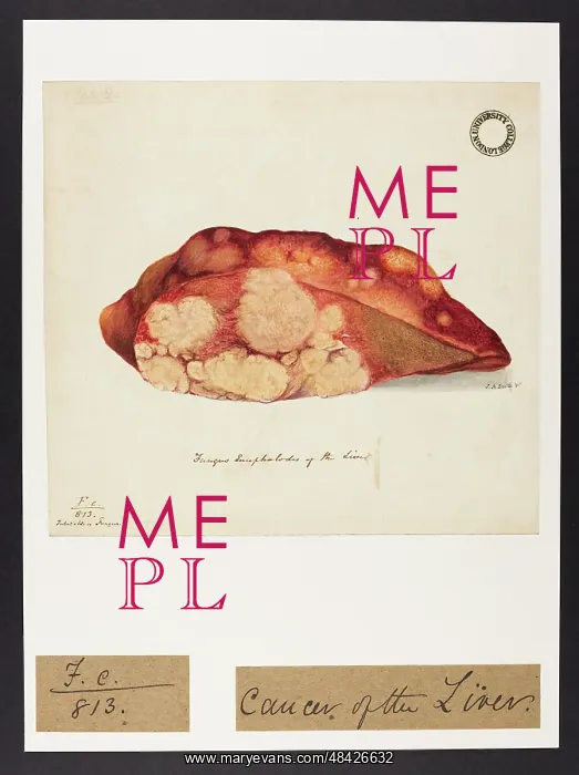 : Fungus Encephalodes of the Liver : Fungus Encephalodes of the Liver