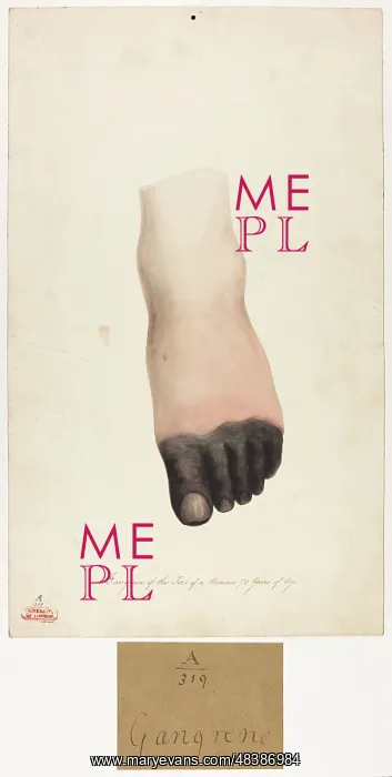  : Gangrene of the Toes