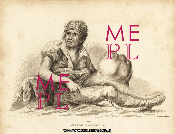 : George Edington with his giant tumor on his leg : George Edington with his giant tumor on his leg
