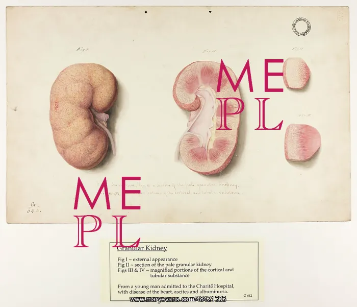 : Granular Kidney : Granular Kidney